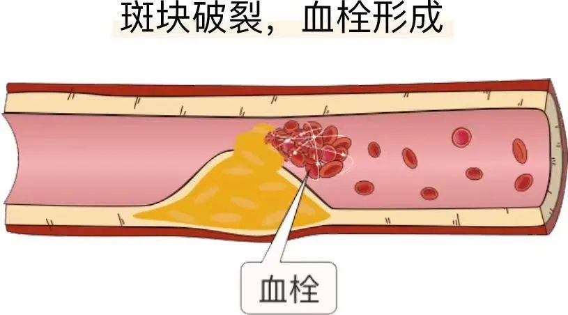 血栓与斑块的区别