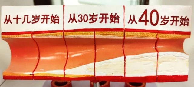 血栓与斑块的区别